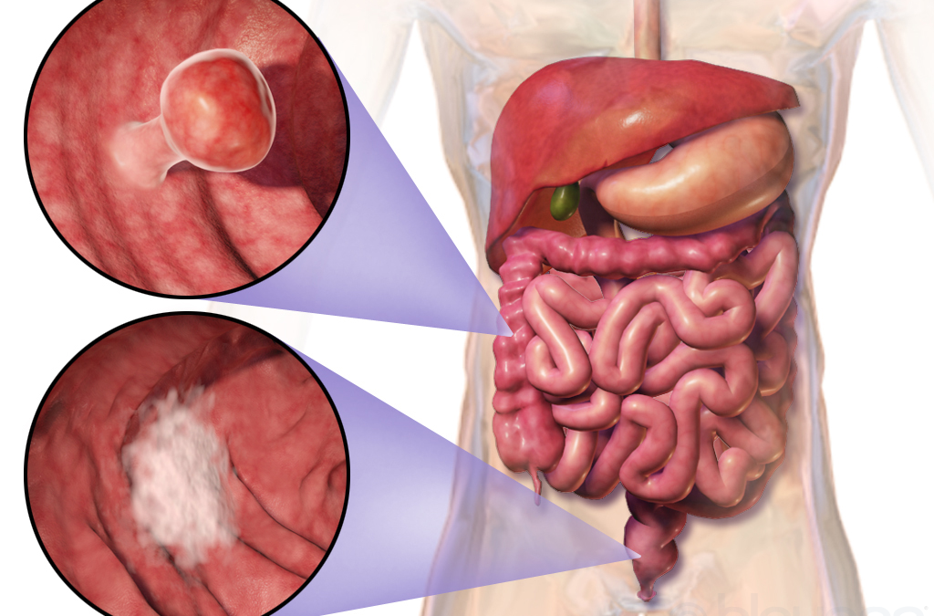 Importancia de la detección temprana de cancer en el colon